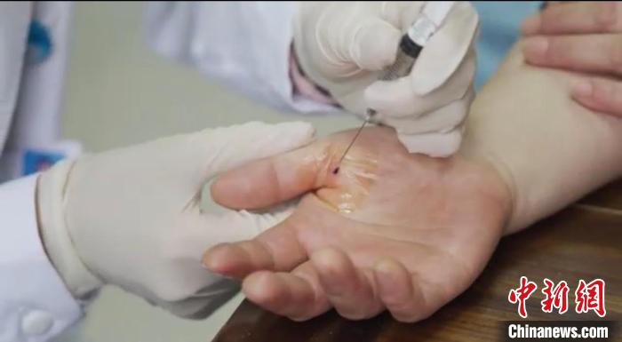 嘉善群眾體驗小針刀?！〖紊平y(tǒng)戰(zhàn) 供圖